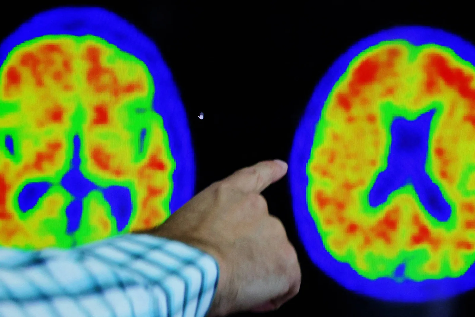 Exames de sangue para Alzheimer custam até R$ 5.000 e exigem indicação médica